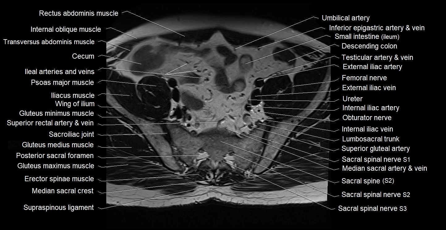 Male pelvis axial cross sectional anatomy image 6.webp